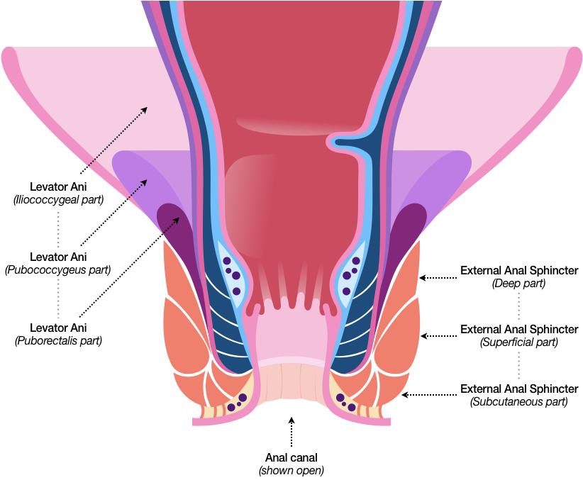 Figure 30 builds on the sketch in Figure 29 by adding a stacked wedge of muscle to represent the Levator Ani and a three-section ring of muscle that is the External Anal Sphincter. The lower part of the Levator Ani is shown converging with connective tissue and the deep part of the External Anal Sphincter. Connective tissue is also present between the subcutaneous part of the External Sphincter, which sits just above the Exterior Rectal Venous Plexus, and the perianal skin. As in the previous sketch, the Anal Canal is shown open.