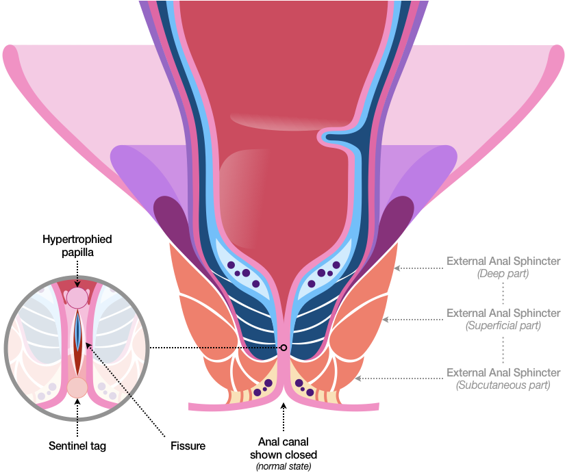 Figure 35 shows the Anorectal Area closed as in Figure 32, but also depicts an anal fissure. In this sketch, round masses of tissue appear above and below the fissure, with one mass, which represents a hypertrophied papilla, occurring at the Pectinate Line, and the other, which is called a sentinel tag, protruding outward at the Anal Verge. The fissure itself is shown as an open split in the Mucosa and Submucosa that exposes the muscle fibers of the Internal Anal Sphincter.