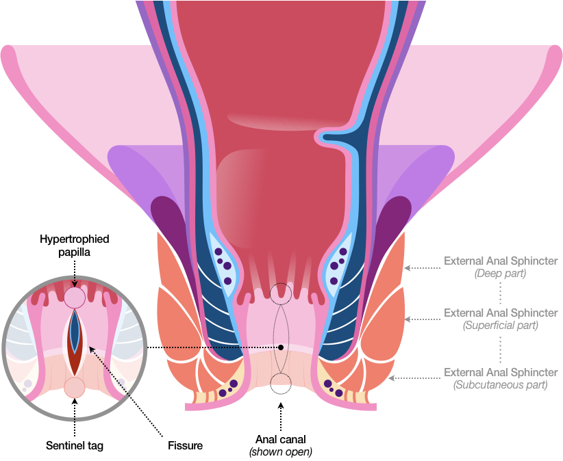 Like Figure 35, Figure 36 shows a fissure affecting the Anoderm from the Pectinate Line to the Anal Verge. However, the Anal Canal is shown open, which has the effect of widening the fissure.